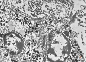 F,21y. | bone marrow - mastocytosis F,21y. | bone marrow - mastocytosis